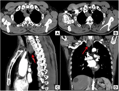 Branchial cleft cyst arising in posterior mediastinum: A case report